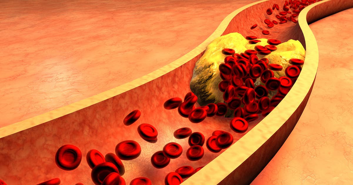 The New “Bad Cholesterol” Shortens Your Life about undefined